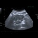 Carcionoid, pancreas, head of pancreas, calcification: US - Ultrasound